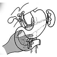 Whipple Procedure